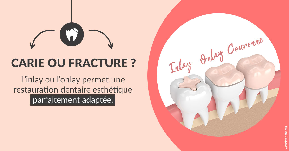 https://dr-edouard-gilles.chirurgiens-dentistes.fr/T2 2023 - Carie ou fracture 2