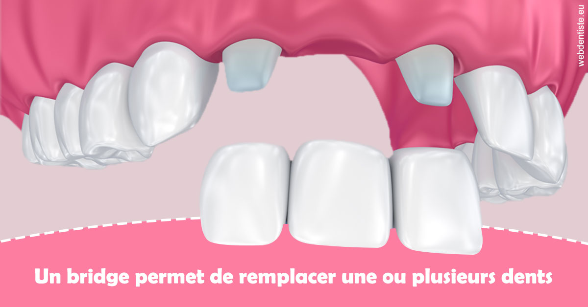 https://dr-edouard-gilles.chirurgiens-dentistes.fr/Bridge remplacer dents 2