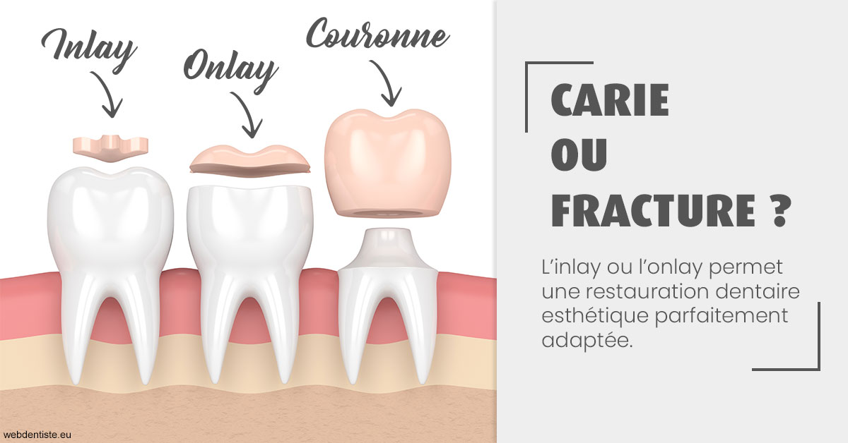 https://dr-edouard-gilles.chirurgiens-dentistes.fr/T2 2023 - Carie ou fracture 1