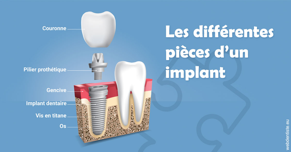 https://dr-edouard-gilles.chirurgiens-dentistes.fr/Les différentes pièces d’un implant 1